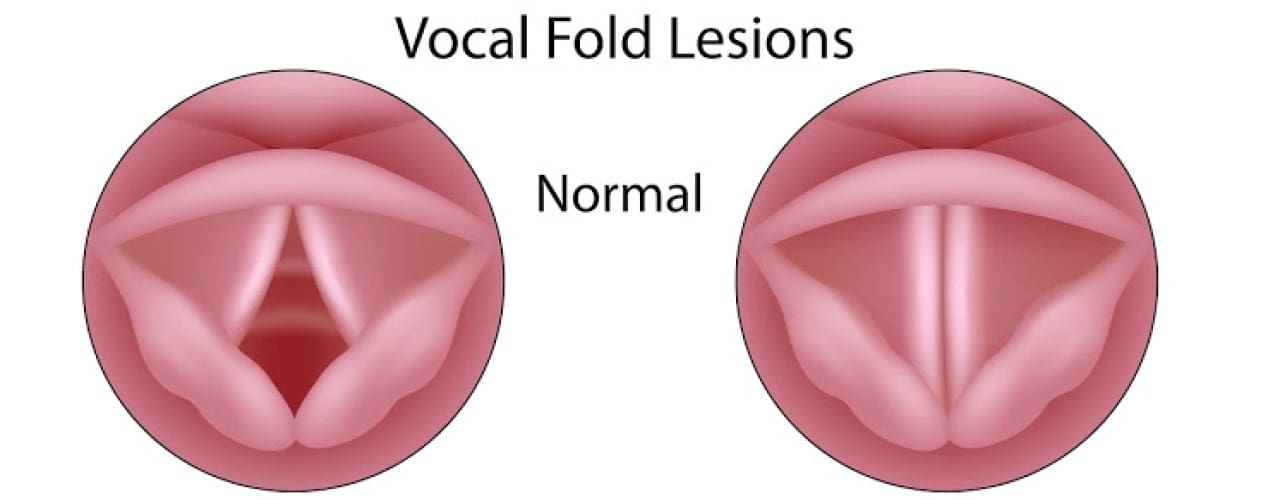 attachment-what-are-the-symptons-of-laryngitis-and-how-can-it-be-treated