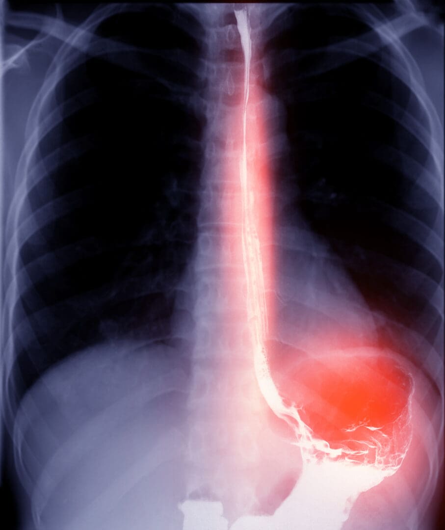 x-ray-image-of-the-stomach-with-barium-contrast