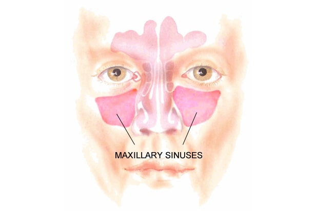 purulent nasal drainage